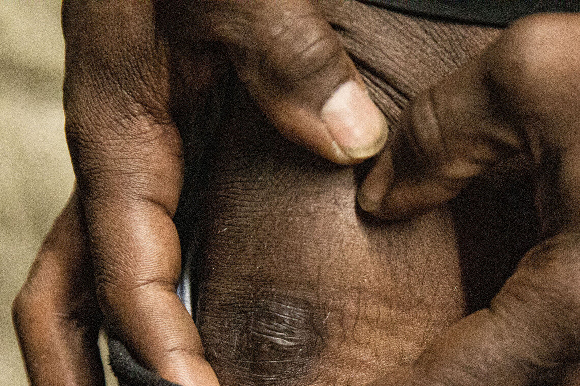 Dean has a scar on his knee, which he said came from being beaten by police officers in 2022.